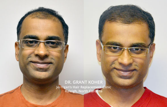 hair-loss-restoration-transplant-raleigh-nc hair loss restoration transplant raleigh nc