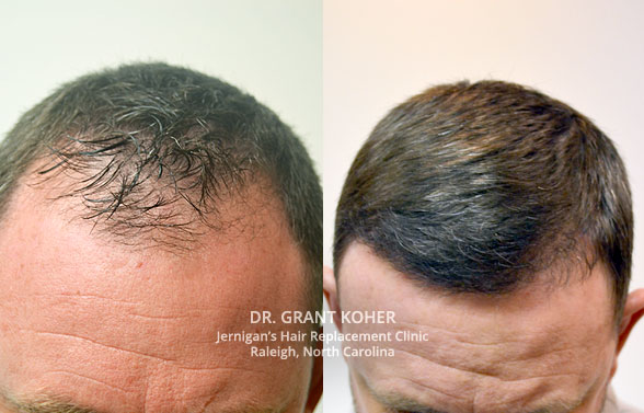 hair-transplants-raleigh-nc surgical hair transplant raleigh nc