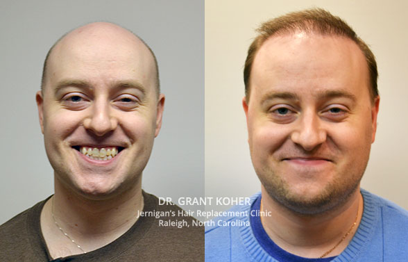 mens-hair-restoration-raleigh-north-carolina mens hair restoration raleigh north carolina